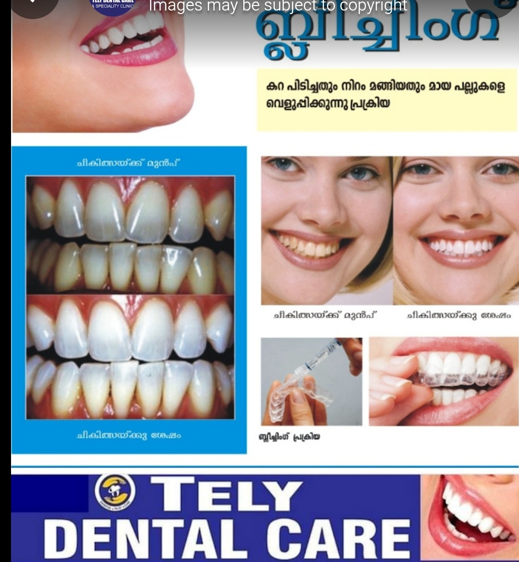 Dental clinic thalassery,Dental doctor thalassery, Tely dental care thalassery 