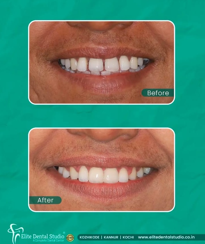 Dental Clinic  Talap Kannur, Dental Doctor   Talap Kannur, Dental Hospital Talap Kannur ,Elite Dental Studio