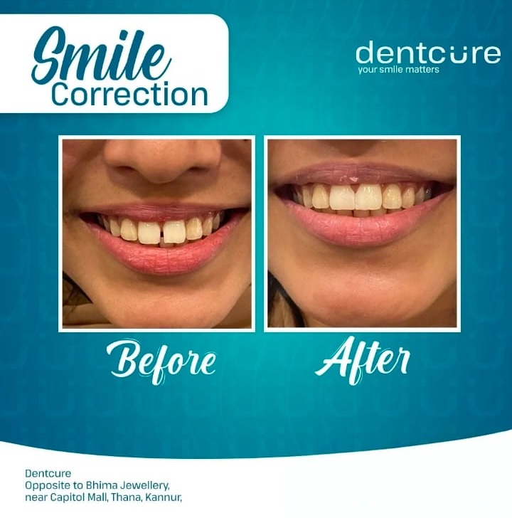 Dental clinic thana kannur,Pediatric dental care thana kannur,Dental hospital thana kannur,Dentcure Dental Clinic 