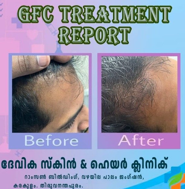 Skin Care Clinic Vazhayila Trivandrum, Hair Care Clinic Vazhayila Trivandrum,Wellness Centre Vazhayila Trivandrum,Devika Skin and Hair Clinic 